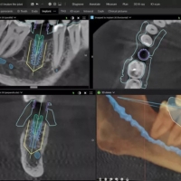 DTX Studio Clinic - surgical template