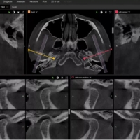 Dexis OP 3D LX - Analyse des ATM