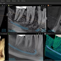 Dexis OP 3D LX - Endodontie