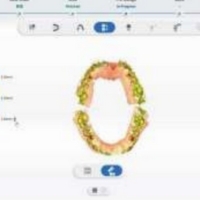 Shining 3D Aoralscan Elite Wireless - Analyse occlusale et vues en coupe
