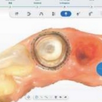 Shining 3D Aoralscan Elite Wireless - Numérisation affinée et extraction automatique des lignes de marge