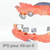 Shining 3D Aoralscan Elite Wireless - Numérisation assistée par IA